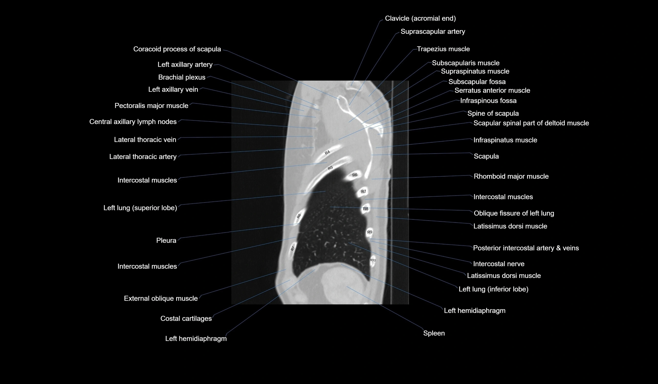 CT chest (thorax) lung window labelled sagittal cross sectional anatomy radiology image-00126.webp